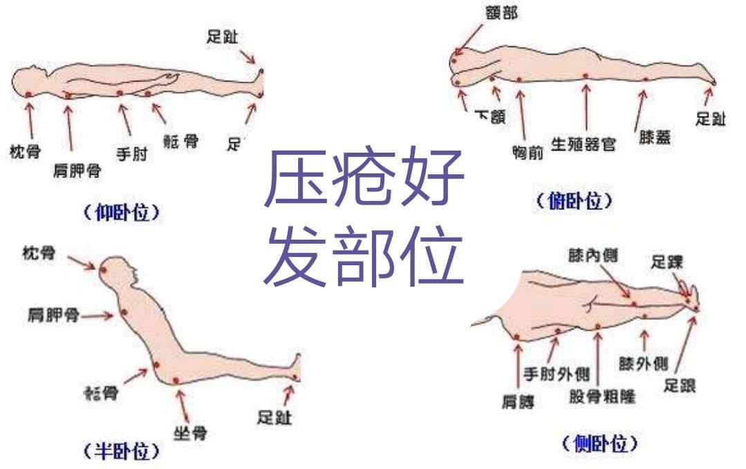 最新压力性损伤分期介绍